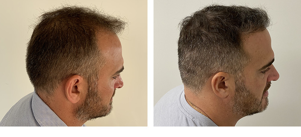 Hair Restoration Results Before and After