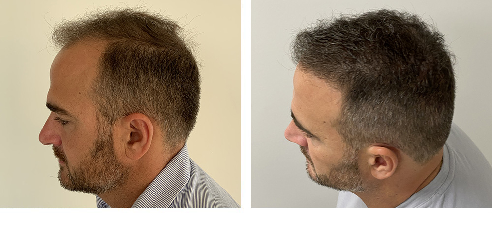 Hair Restoration Results Before and After