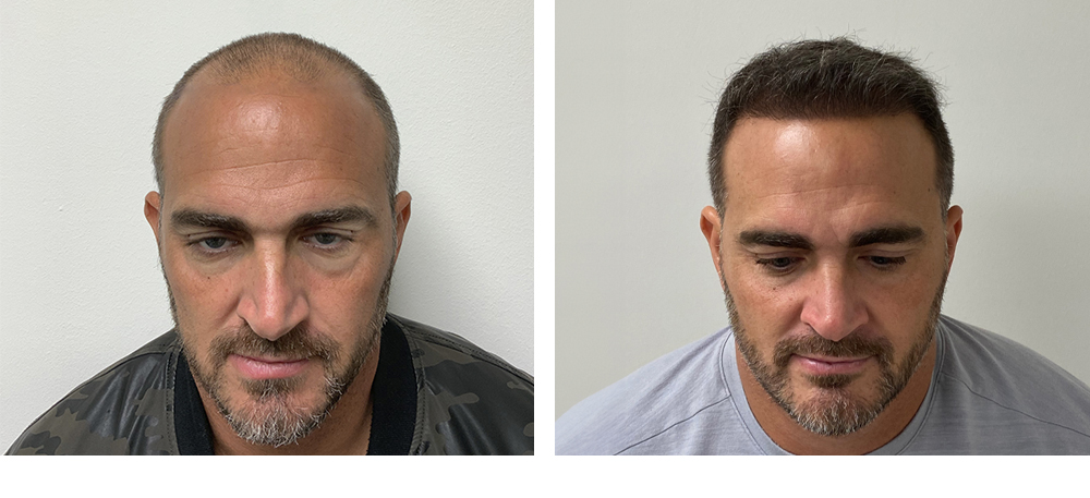 Hair Restoration Results Before and After