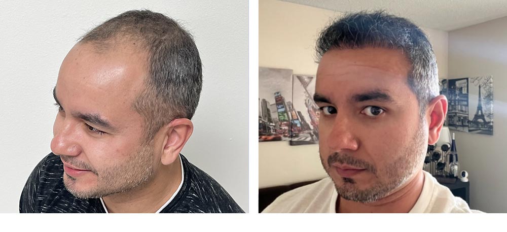 Hair Restoration Results Before and After