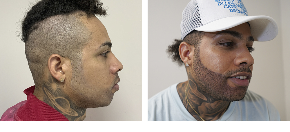 Hair Restoration Results Before and After