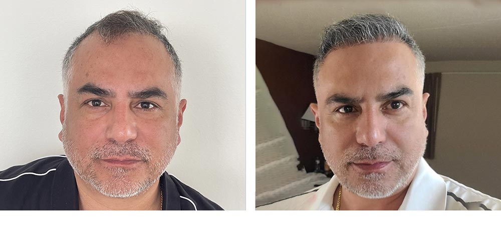 Hair Restoration Results Before and After