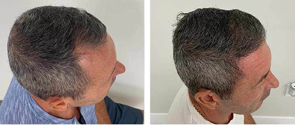 Hair Restoration Results Before and After