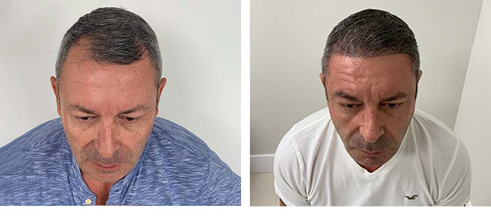 Hair Restoration Results Before and After