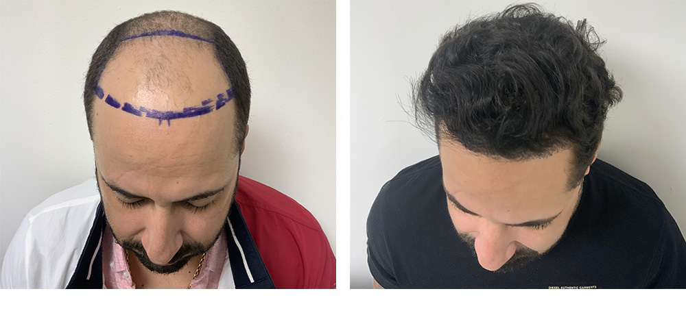Hair Restoration Results Before and After