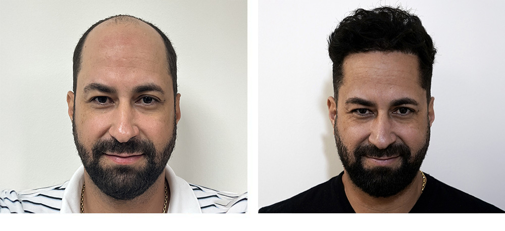 Hair Restoration Results Before and After