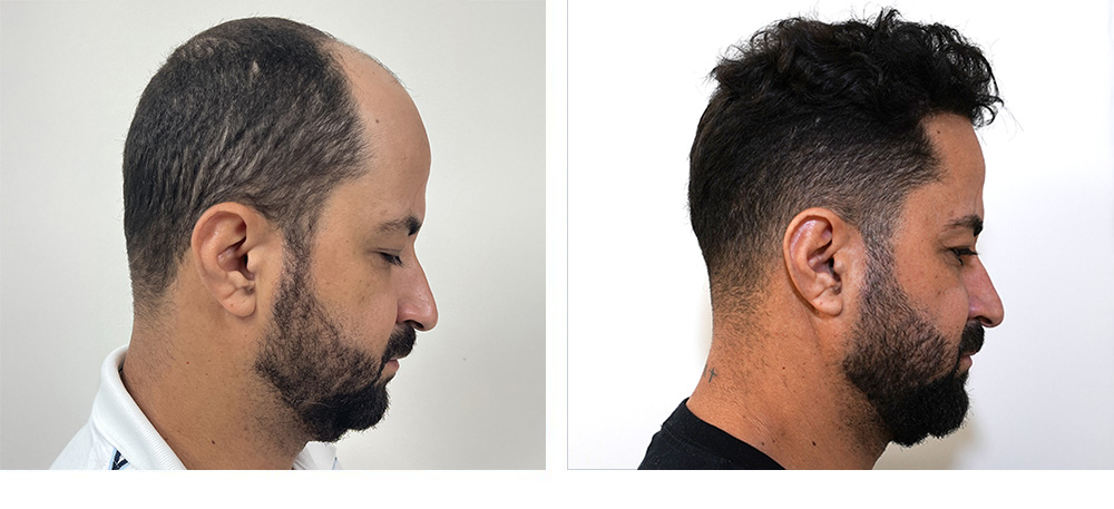 Hair Restoration Results Before and After