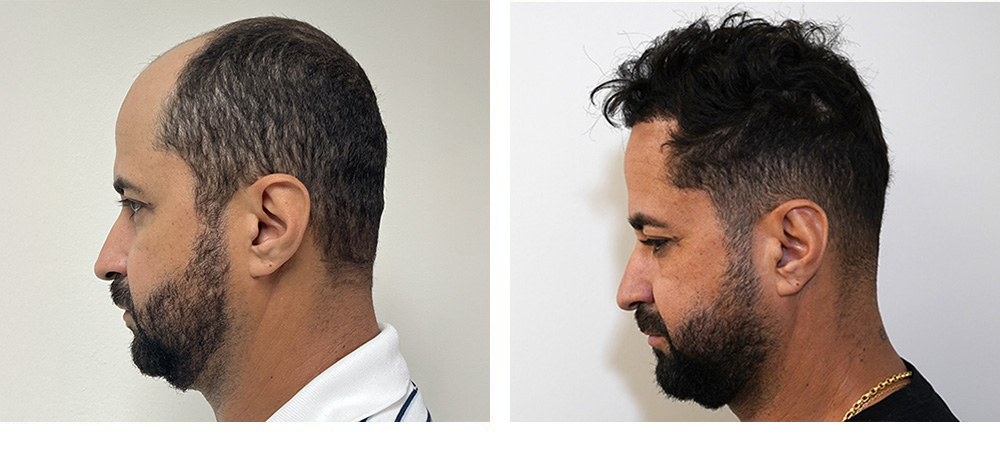 Hair Restoration Results Before and After