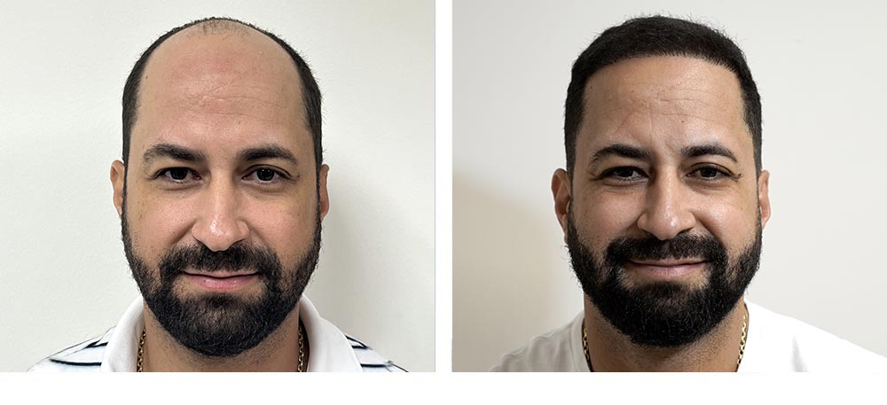 Hair Restoration Results Before and After