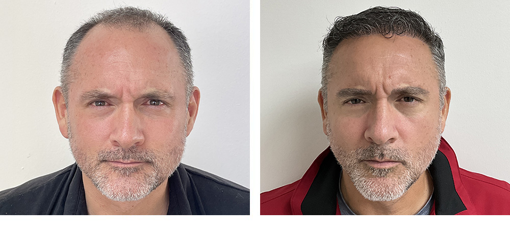 Hair Restoration Results Before and After
