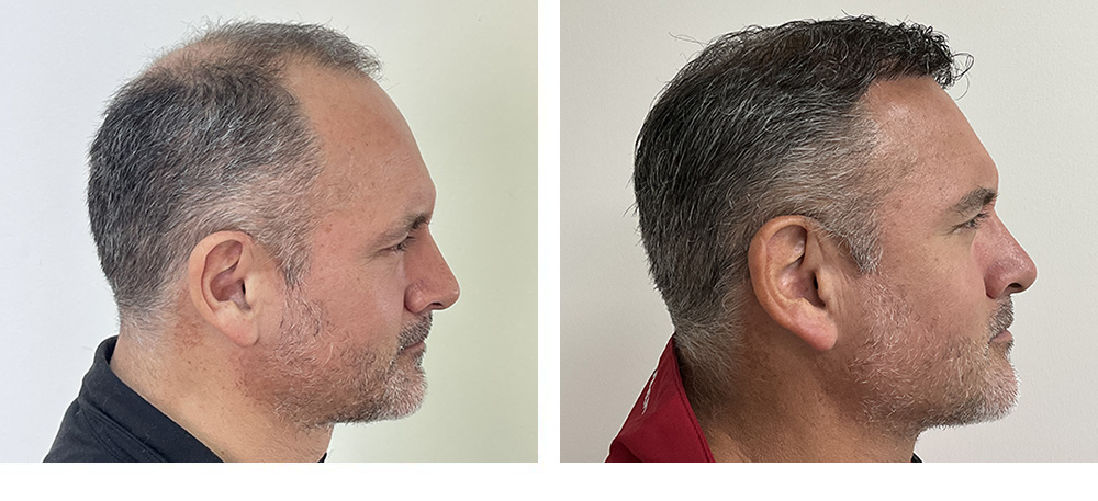 Hair Restoration Results Before and After