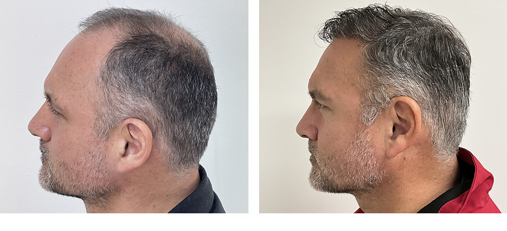 Hair Restoration Results Before and After