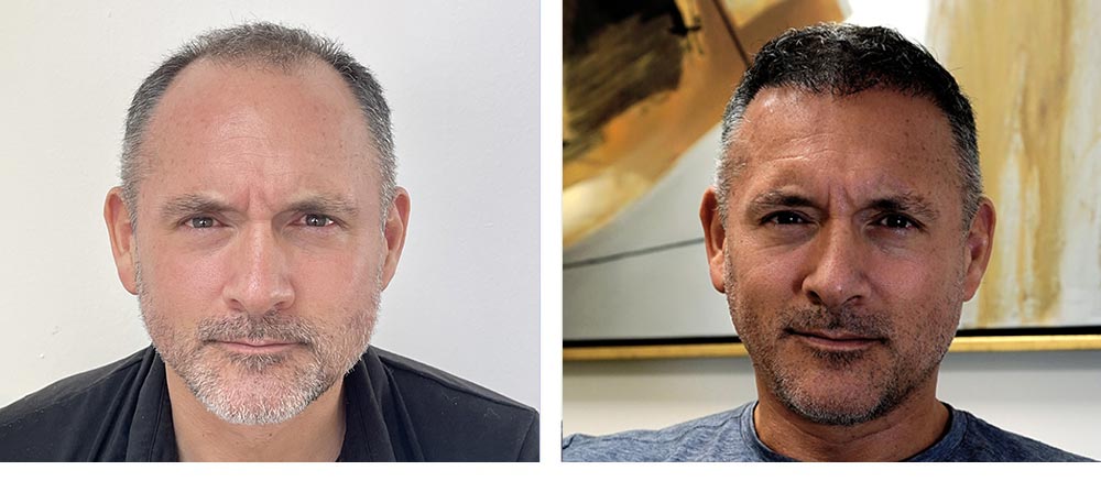 Hair Restoration Results Before and After