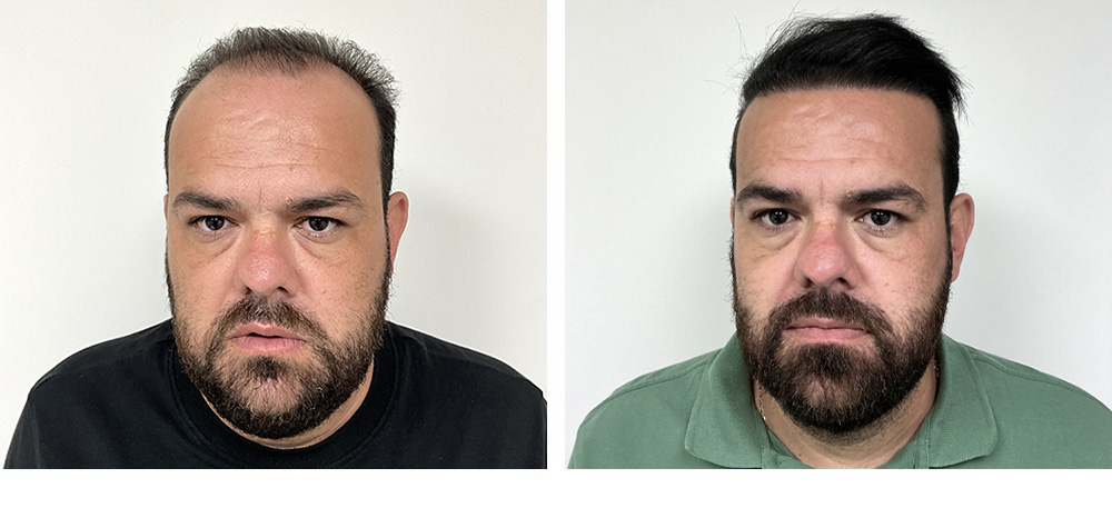 Hair Transplant Before and After