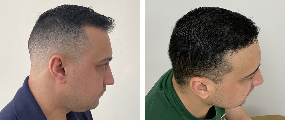 Hair Restoration Results Before and After