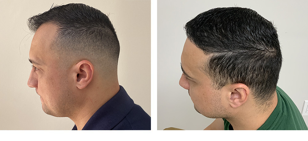 Hair Restoration Results Before and After