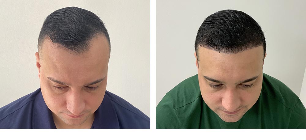 Hair Restoration Results Before and After