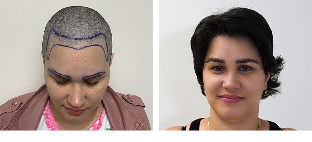 Hair Restoration Results Before and After