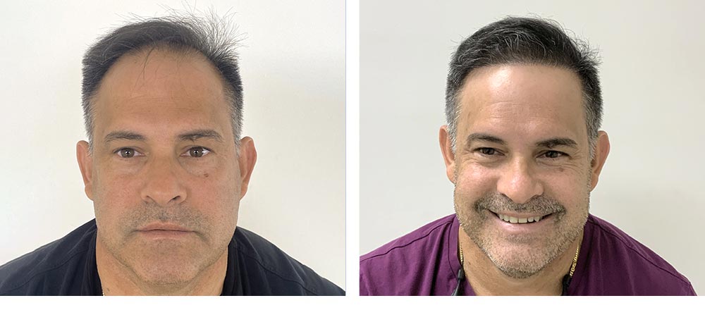 Hair Restoration Results Before and After