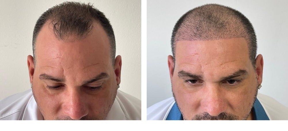 Hair Restoration Results Before and After