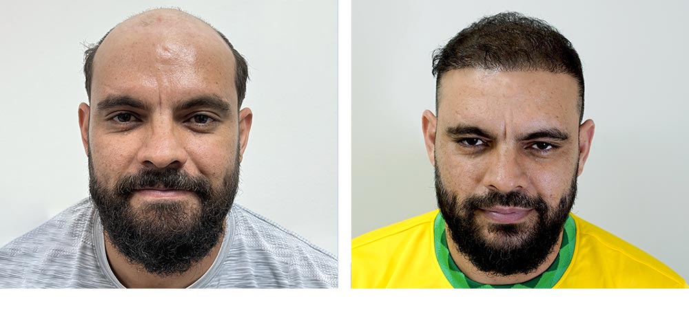 Hair Restoration Results Before and After