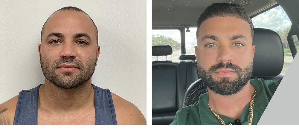 Hair Restoration Results Before and After