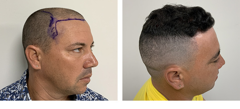 Hair Restoration Results Before and After