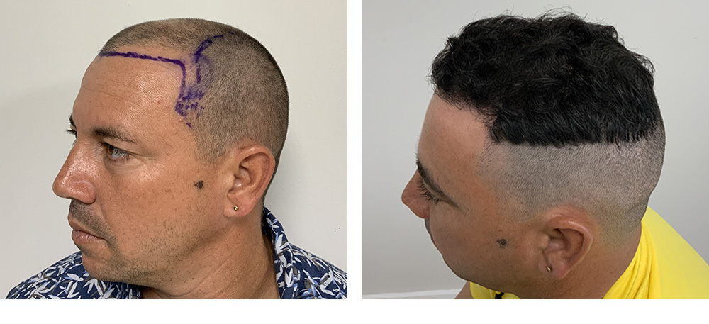 Hair Restoration Results Before and After