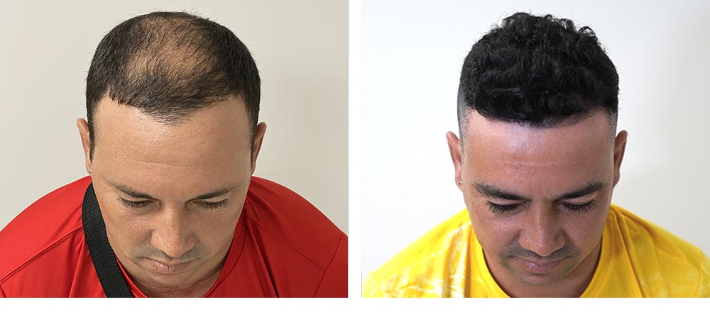 Hair Restoration Results Before and After