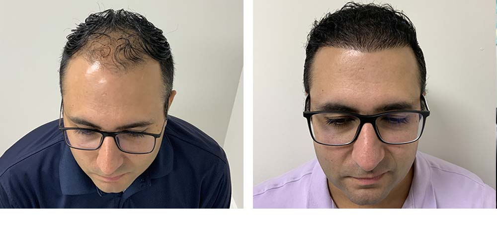 Hair Restoration Results Before and After