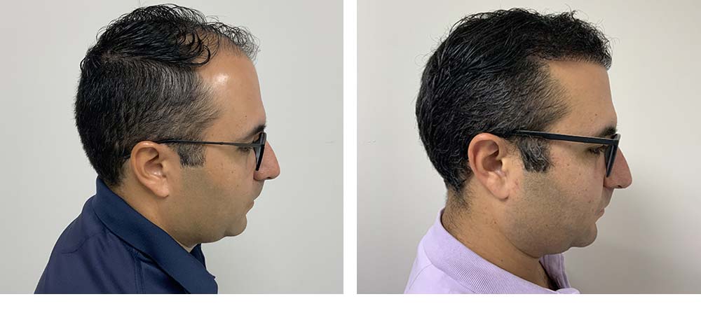 Hair Restoration Results Before and After