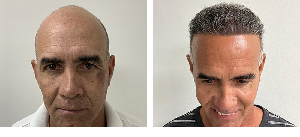 hair transplant before and after in miami