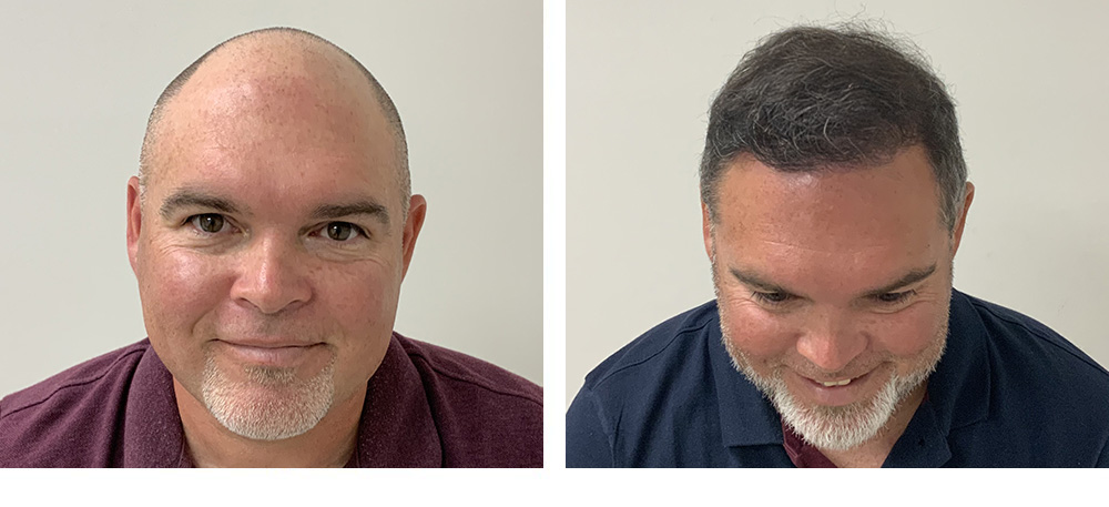Hair Restoration Results Before and After