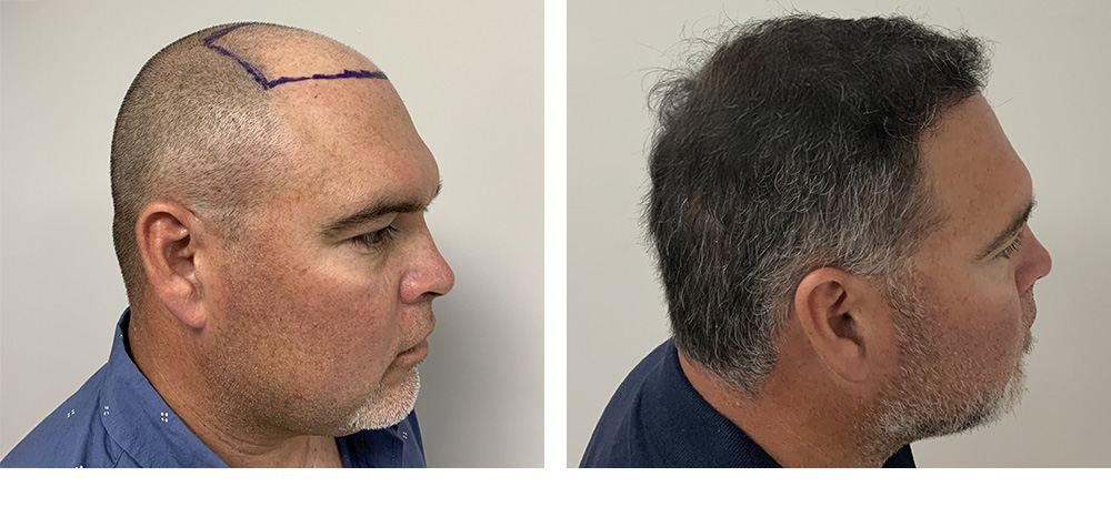 Hair Restoration Results Before and After