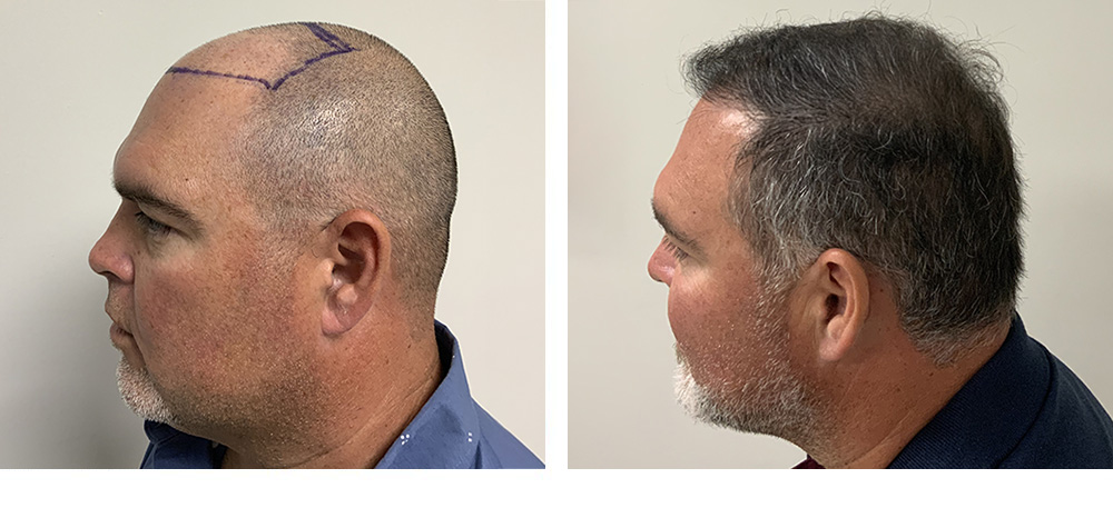 Hair Restoration Results Before and After