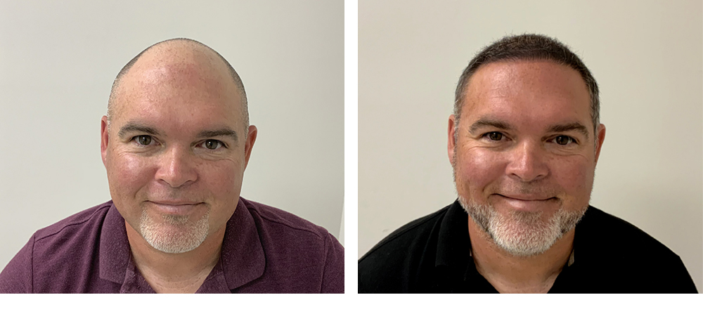 Hair Restoration Results Before and After