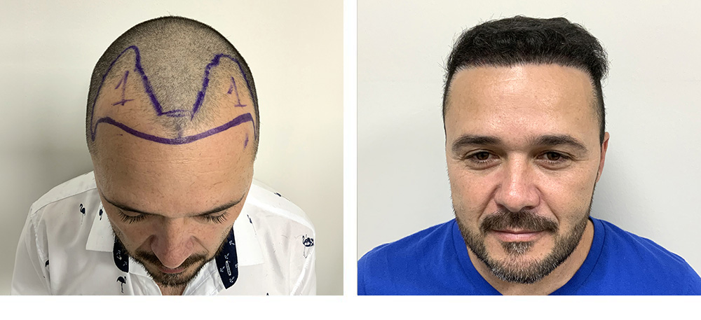 Hair Transplant Before and After
