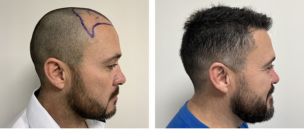 Hair Transplant Before and After