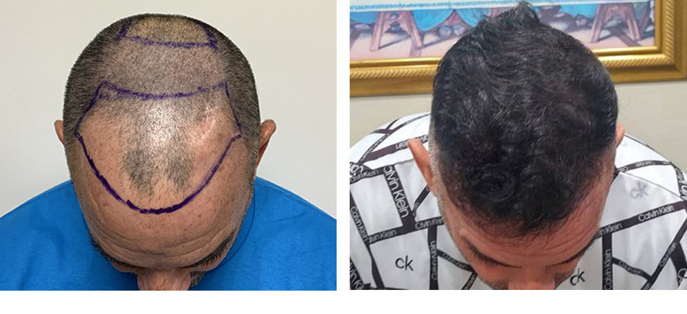 Hair Transplant Before And After