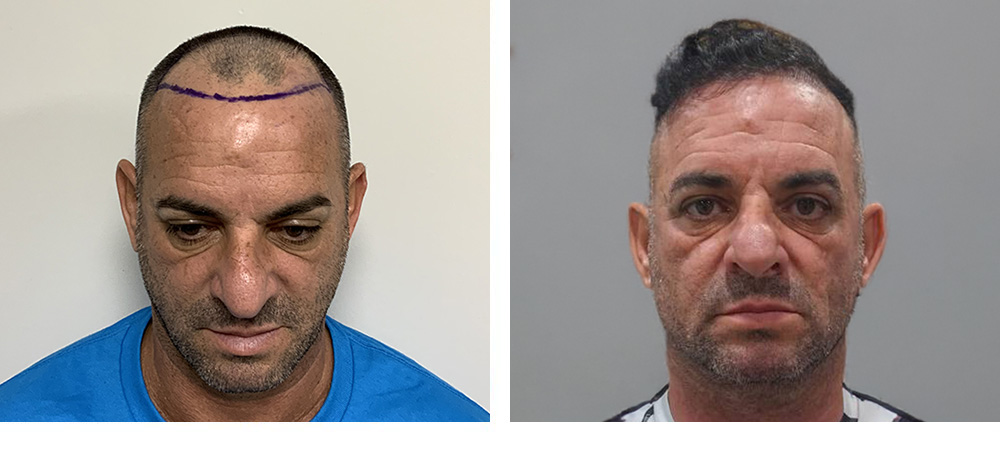 Hair Transplant Before And After