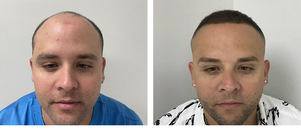 Hair Restoration Results Before and After