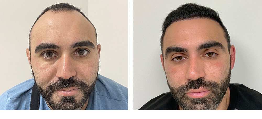 Hair Transplant Before And After in Miami