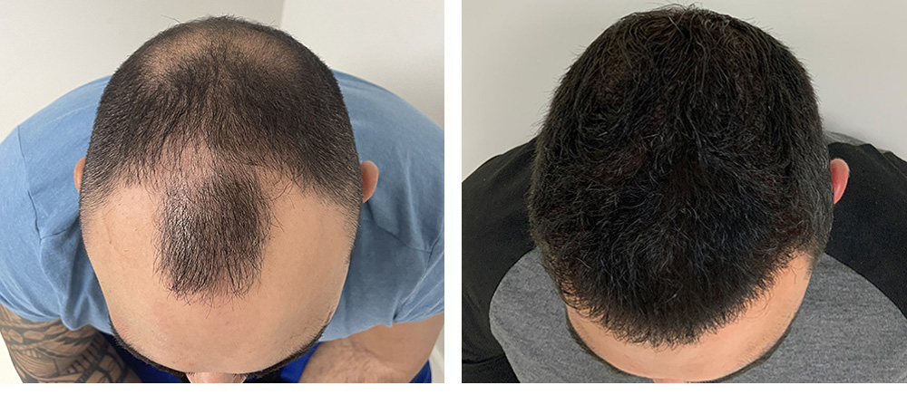 Hair Transplant Before And After in Miami