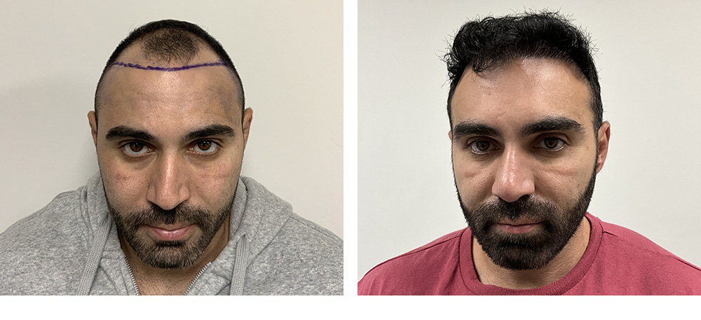 Hair Transplant Before And After in Miami