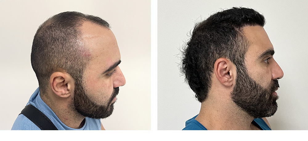 Hair Transplant Before And After in Miami
