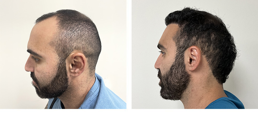 Hair Transplant Before And After in Miami