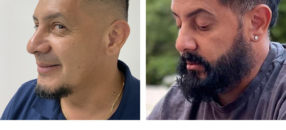 Beard Hair Transplant Before and After