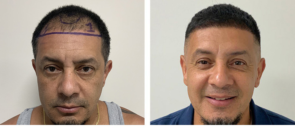Hair Transplant Before And After