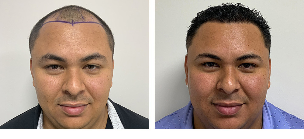 Hair Transplant Before And After in Miami