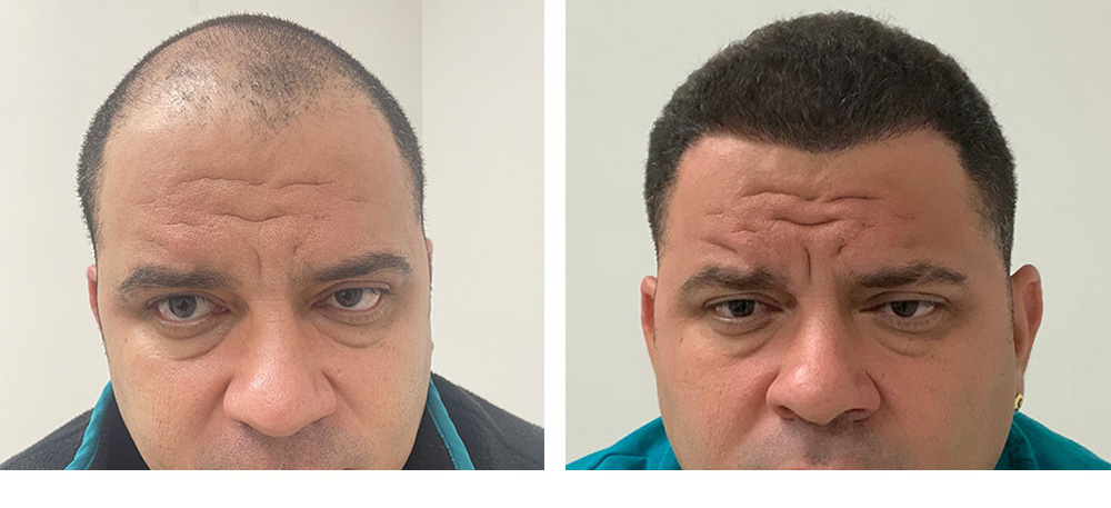 Hair Transplant before and after in miami